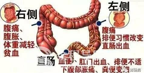 結(jié)直腸癌離我們遠嗎？徐州市腫瘤醫(yī)院胃腸外科專家這么說